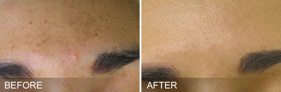 Before and After HyrdaFacial Brown Spot Removal Colleyville