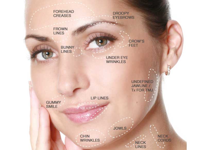 best parts of body to treat with botox