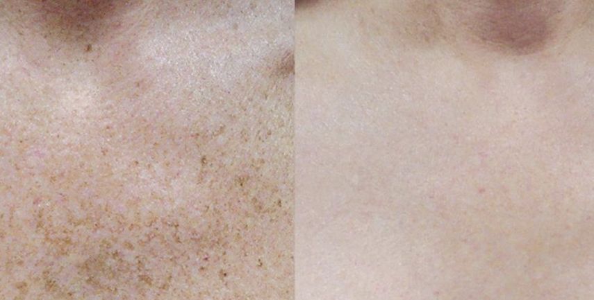 Before and after IPL Photofacial Make You Well Torrance